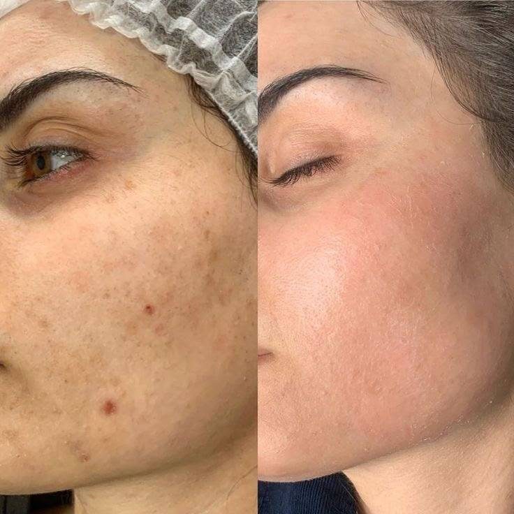نتیجهٔ رفع لک و یکدست‌شدن پوست صورت در کلینیک لوتوس