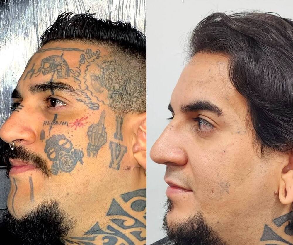 نمونه روند حذف تتو در کلینیک لوتوس